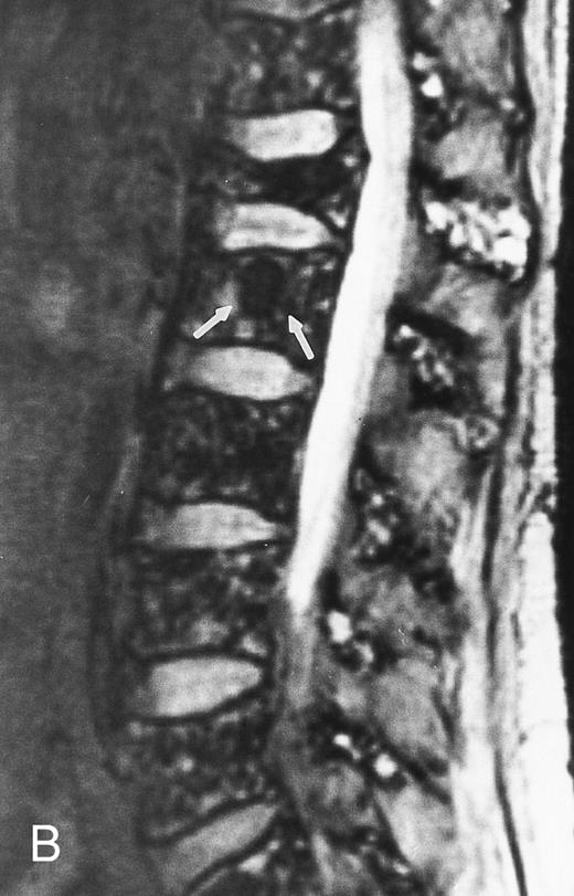 Fig. 6. Variegated MR pattern of abnormal marrow in a 45-year-old man with multiple myeloma: T1-weighted (600/20, TR/TE) (A), relatively T2-weighted gradient recalled echo (650/20, TR/TE, flip angle 20°) (B), and enhanced T1-weighted (600/20, TR/TE ) (C) sagittal MR images of the lumbar spine show multiple tiny foci of marrow involvement. Arrows point to island of normal fatty marrow. Sagittal T1-weighted (600/20, TR/TE) MR image 6 months after initiation of chemotherapy (D) shows reappearance of fatty marrow in the spine. Note development of multiple vertebral collapses. T1-weighted MR image 1 year after bone marrow transplantation and total body irradiation (600/20, TR/TE) (E) shows resolution of marrow abnormality and homogeneous bright signal of fatty marrow in the lumbar spine. Note progression of compression fractures. Reprinted with permission from Moulopoulos et al.14,21