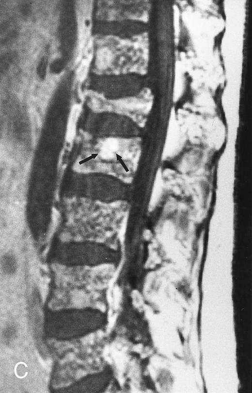 Fig. 6. Variegated MR pattern of abnormal marrow in a 45-year-old man with multiple myeloma: T1-weighted (600/20, TR/TE) (A), relatively T2-weighted gradient recalled echo (650/20, TR/TE, flip angle 20°) (B), and enhanced T1-weighted (600/20, TR/TE ) (C) sagittal MR images of the lumbar spine show multiple tiny foci of marrow involvement. Arrows point to island of normal fatty marrow. Sagittal T1-weighted (600/20, TR/TE) MR image 6 months after initiation of chemotherapy (D) shows reappearance of fatty marrow in the spine. Note development of multiple vertebral collapses. T1-weighted MR image 1 year after bone marrow transplantation and total body irradiation (600/20, TR/TE) (E) shows resolution of marrow abnormality and homogeneous bright signal of fatty marrow in the lumbar spine. Note progression of compression fractures. Reprinted with permission from Moulopoulos et al.14,21