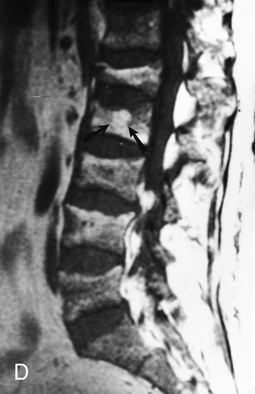 Fig. 6. Variegated MR pattern of abnormal marrow in a 45-year-old man with multiple myeloma: T1-weighted (600/20, TR/TE) (A), relatively T2-weighted gradient recalled echo (650/20, TR/TE, flip angle 20°) (B), and enhanced T1-weighted (600/20, TR/TE ) (C) sagittal MR images of the lumbar spine show multiple tiny foci of marrow involvement. Arrows point to island of normal fatty marrow. Sagittal T1-weighted (600/20, TR/TE) MR image 6 months after initiation of chemotherapy (D) shows reappearance of fatty marrow in the spine. Note development of multiple vertebral collapses. T1-weighted MR image 1 year after bone marrow transplantation and total body irradiation (600/20, TR/TE) (E) shows resolution of marrow abnormality and homogeneous bright signal of fatty marrow in the lumbar spine. Note progression of compression fractures. Reprinted with permission from Moulopoulos et al.14,21