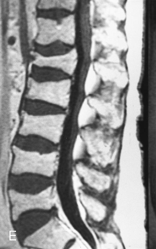Fig. 6. Variegated MR pattern of abnormal marrow in a 45-year-old man with multiple myeloma: T1-weighted (600/20, TR/TE) (A), relatively T2-weighted gradient recalled echo (650/20, TR/TE, flip angle 20°) (B), and enhanced T1-weighted (600/20, TR/TE ) (C) sagittal MR images of the lumbar spine show multiple tiny foci of marrow involvement. Arrows point to island of normal fatty marrow. Sagittal T1-weighted (600/20, TR/TE) MR image 6 months after initiation of chemotherapy (D) shows reappearance of fatty marrow in the spine. Note development of multiple vertebral collapses. T1-weighted MR image 1 year after bone marrow transplantation and total body irradiation (600/20, TR/TE) (E) shows resolution of marrow abnormality and homogeneous bright signal of fatty marrow in the lumbar spine. Note progression of compression fractures. Reprinted with permission from Moulopoulos et al.14,21