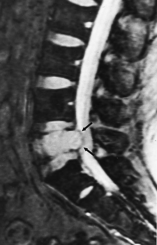 Fig. 7. A 38-year-old man with solitary plasmacytoma of L5. Relatively T2-weighted gradient recalled echo (400/21, TR/TE, flip angle 20°) sagittal MR image of the lumbar spine shows bright signal of mass in L5 and extension of tumor into the spinal canal (arrows) with impingement of the thecal sac.