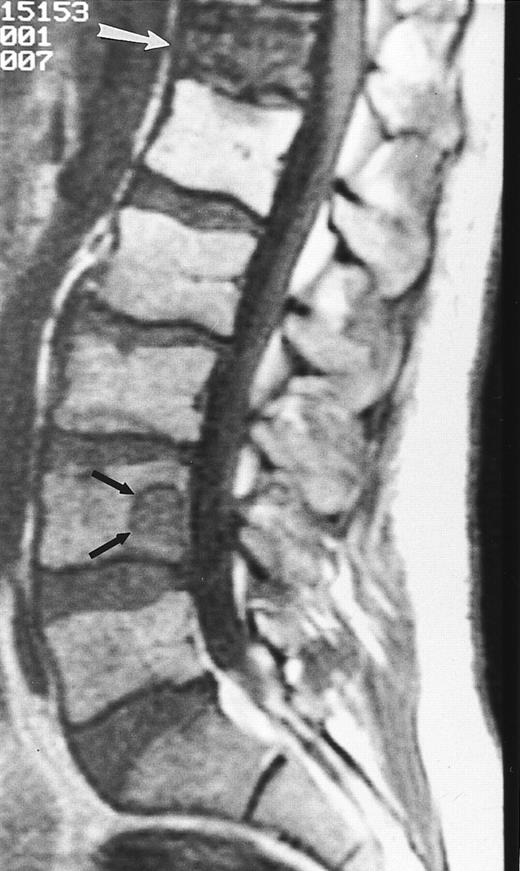 Fig. 8. A 38-year-old man with solitary bone plasmacytoma and unsuspected lesions on MR images. Sagittal T1-weighted (600/20, TR/TE) MR image of the spine shows primary tumor in T12 (arrow) and additional focus of disease in L4 (short arrows). Conventional radiographs and CT scans failed to show the lesion in L2. Note characteristic postradiation bright signal in L1.