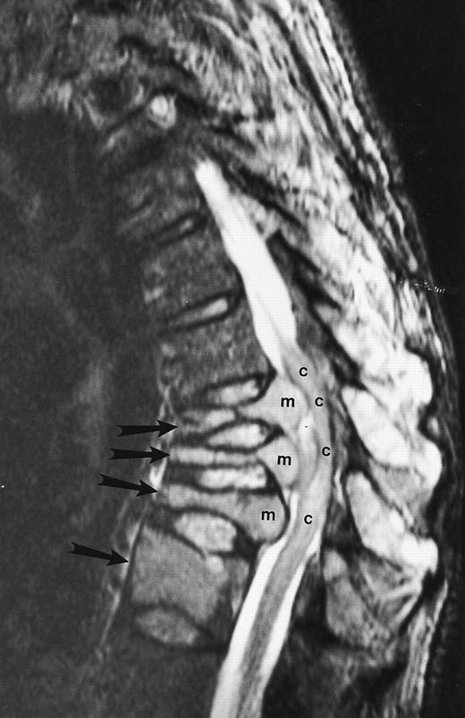 Fig. 9. An 82-year-old man with multiple myeloma and cord compression. T2-weighted, fat-suppressed fast spin echo (5000/96, TR/TE, ET16) sagittal MR image of the thoracic spine shows abnormal signal in several compressed vertebral bodies (arrows). The spinal cord (c) is severely compressed by epidural mass (m).