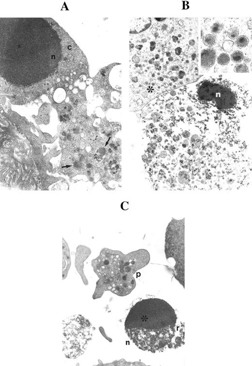 Fig. 3. Ultrastructural examination of CD34-derived apoptotic megakaryocytes. (A) shows an apoptotic nucleus (n) surrounded by a short rim of cytoplasm (c) in continuity with a portion of granulated (arrows) cytoplasm. OM × 8,000. (B) shows a late apoptotic nucleus (n) surrounded by granulated cytoplasm. Also note that the apoptotic nucleus is in close proximity to a normal megakaryocyte (*) showing the typical dense core granules. OM × 6,000. Inset shows a higher magnification of dense core granules (OM × 60,000). (C) shows an apoptotic micronucleus (n) with the characteristic chromatin cap (*) and cytoplasmic remnants (r) in proximity to a mature platelet (p). OM × 8,000.