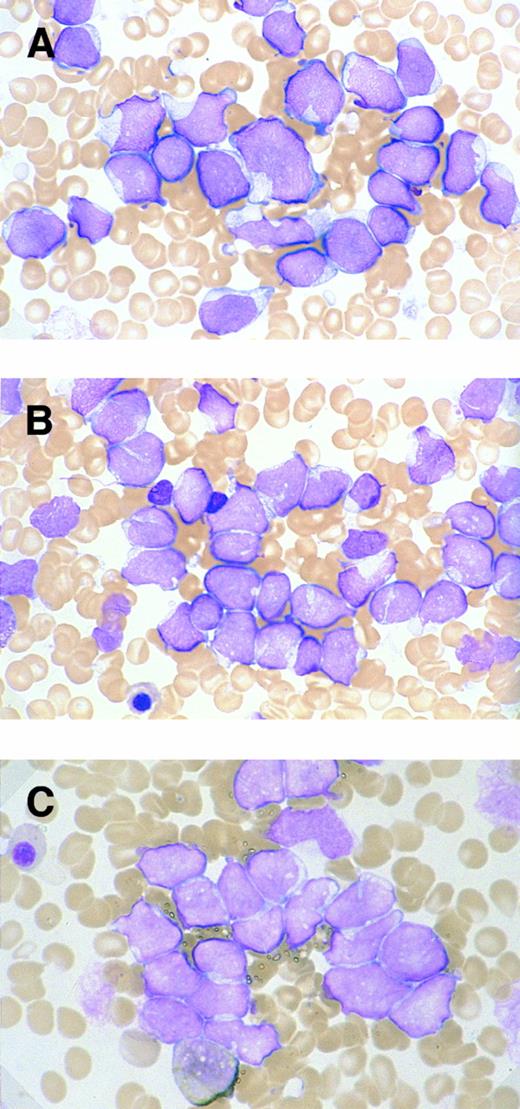 Fig. 1. Morphologic and cytochemical features of myeloid/NK cell precursor acute leukemia. MG-stained bone marrow smear of patients no. 4 (A) and no. 3 (B). (A) The leukemic cells show a L2-shaped morphology, with varying cell size, irregular nuclei with prominent nucleoli, and pale cytoplasm. Azurophilic granules are not apparent in the cytoplasm (original magnification × 1,200). (B) The leukemic cells present with unremarkable nucleoli and some with deeply invaginated nuclear membrane (original magnification × 1,200). (C) MPO-stained bone marrow smear of patient no. 3. Less than 3% of leukemic cells are positive for MPO staining (original magnification × 1,200).