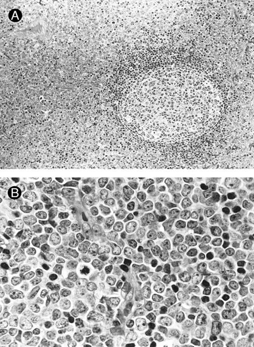 Fig. 2. Lymph node biopsies of patients no. 1 (A and B), no. 3 (C), and no. 4 (D). (A) Diffuse infiltration of tumor cells is noted in a T-zone area with sparing of follicles (original magnification × 100). (B and C) The component cells show blastic morphology with round to moderately irregular nuclei, small to intermediate-sized nucleoli, and scant cytoplasm (original magnification × 600). (D) The tumor cells show irregular nuclei with inconspicuous nucleoli.