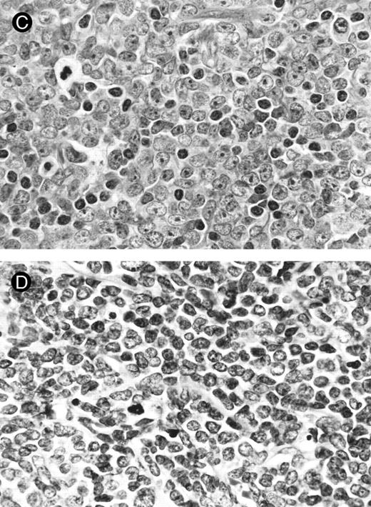 Fig. 2. Lymph node biopsies of patients no. 1 (A and B), no. 3 (C), and no. 4 (D). (A) Diffuse infiltration of tumor cells is noted in a T-zone area with sparing of follicles (original magnification × 100). (B and C) The component cells show blastic morphology with round to moderately irregular nuclei, small to intermediate-sized nucleoli, and scant cytoplasm (original magnification × 600). (D) The tumor cells show irregular nuclei with inconspicuous nucleoli.