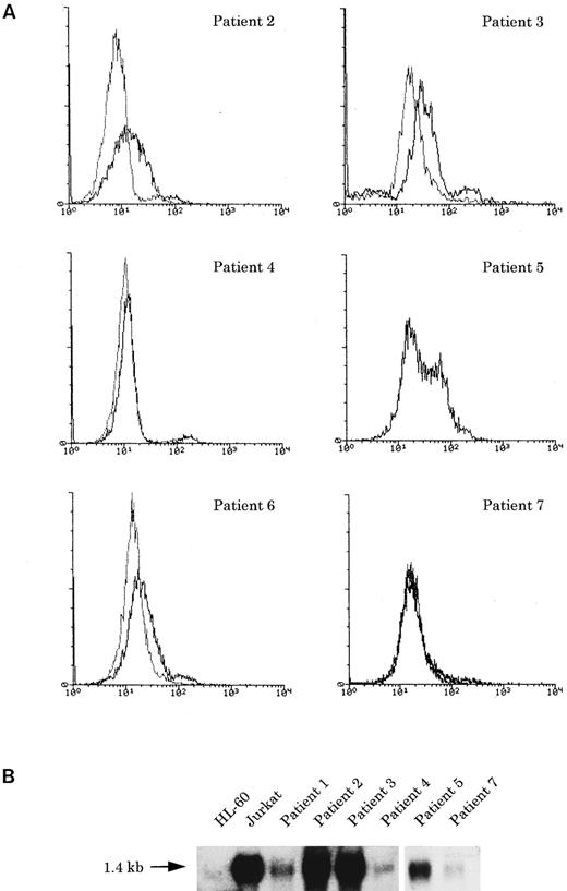 Fig. 3. (A) Flow cytometric analysis of cyCD3 in myeloid/NK cell precursor leukemia cases. The x-axis represents fluorescence intensity (4-decade log scale) and the y-axis the relative cell number. The thick line indicates the histogram for leukemic cells stained with cyCD3 and the thin line indicates the histogram for leukemic cells stained with cyCD22 (negative control). The right shift of the histogram wave observed in patients nos. 2, 3, and 6 indicates that the leukemic cells are cyCD3 dimly positive. In patient no. 2, the fluorescence intensity of 18% of the leukemic cells was calculated to exceed the cut-off level (maximum intensity of negative control), but most (approximately more than 80% to 90%) of them are dimly positive. In patient no. 5, the cyCD22 analysis was not available. (B) CD3ε expression by Northern blotting analysis. HL-60 was used as a negative control and Jurkat was used as a positive control. All six cases expressed CD3ε mRNA to varying extents.