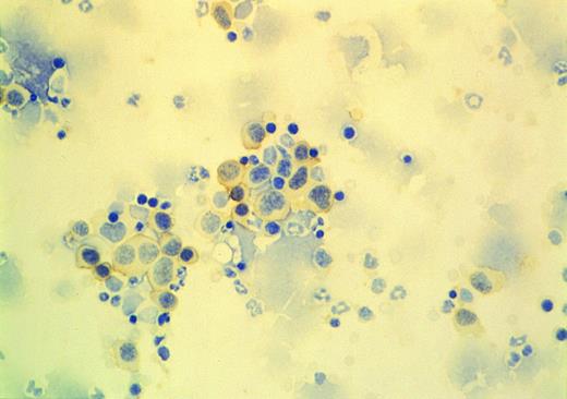 Fig. 2. Immunostaining of bone marrow cells from the tumor bearing mice (see Fig 1). Cells were adhered to slides by centrifugation, then stained with anti-CD38 antibody. CD38 expressing cells (stained to brown) showed large, cytoplasm-rich and plasmablastic morphology.
