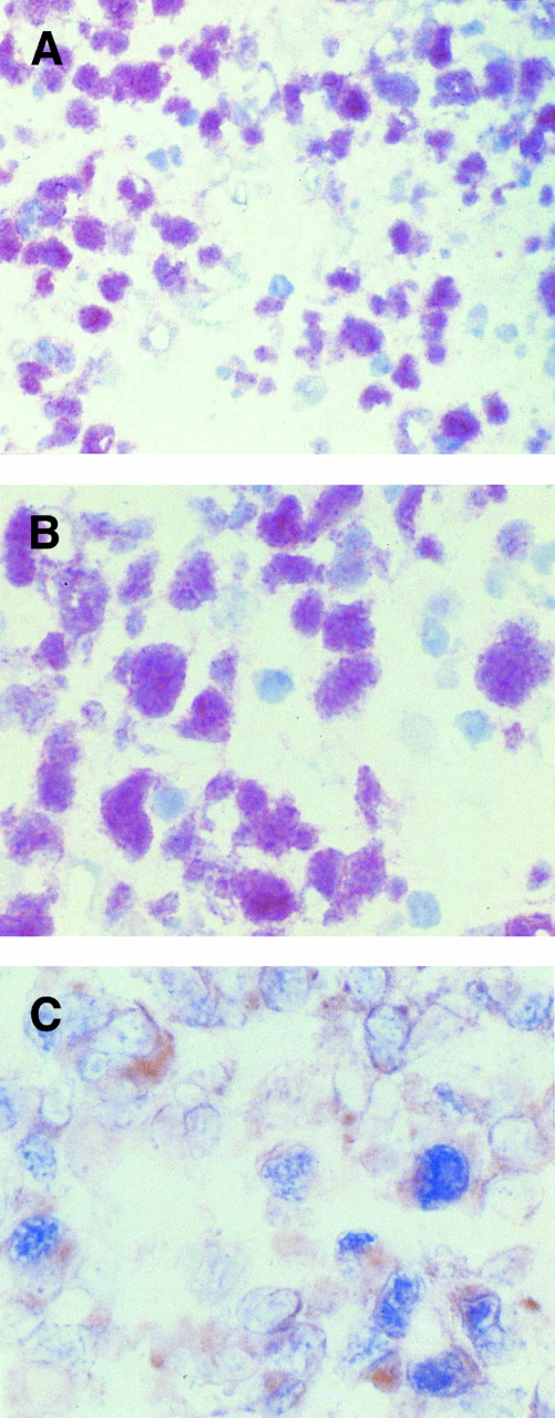 Fig. 1. (A and B) Immunohistochemical demonstration of BCL-6 protein expression in a CD30+ anaplastic large-cell lymphoma employing the APAAP method on frozen tissue sections. (A) In this field several tumor cells show a nuclear staining pattern with anti–BCL-6 MoAb PG-B6. (B) Anaplastic large cells show strong nuclear immunoreactivity with the anti–BCL-6 MoAb PG-B6. The positivity is microgranular. (C) Coexpression of BCL-6 protein (nuclear, blue) is observed in a proportion of CD30+ (cytoplasmic and membranous, reddish) anaplastic large tumor cells, as detected by two-color staining (see Materials and Methods). Original magnification (A) ×250, (B) ×400, and (C) ×400.