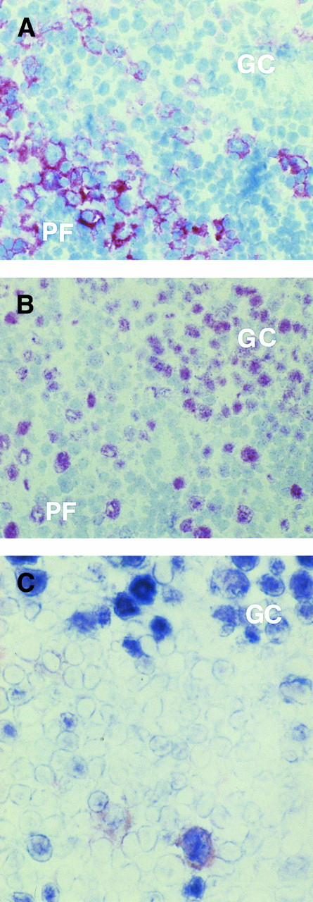 Fig. 2. (A and B) Serial sections from a reactive lymph node with non-neoplastic T-cell proliferation. Several CD30+ (A) and BCL-6+ (B) large lymphocytes are present at the margins of a germinal center (GC), although they are also seen in the perifollicular (PF ) zone. Within the GC numerous B cells stain for BCL-6 (B), whereas cells positive for CD30 are absent (A). (C) A large cell near to a GC coexpresses CD30 antigen (reddish) and BCL-6 protein (blue), as detected by two-color staining (see Materials and Methods). No coexpression by the BCL-6+ GC cells is detectable. (A and B) APAAP immunostaining, hematoxylin counterstain, original magnification ×250; (C) frozen section, original magnification ×400.