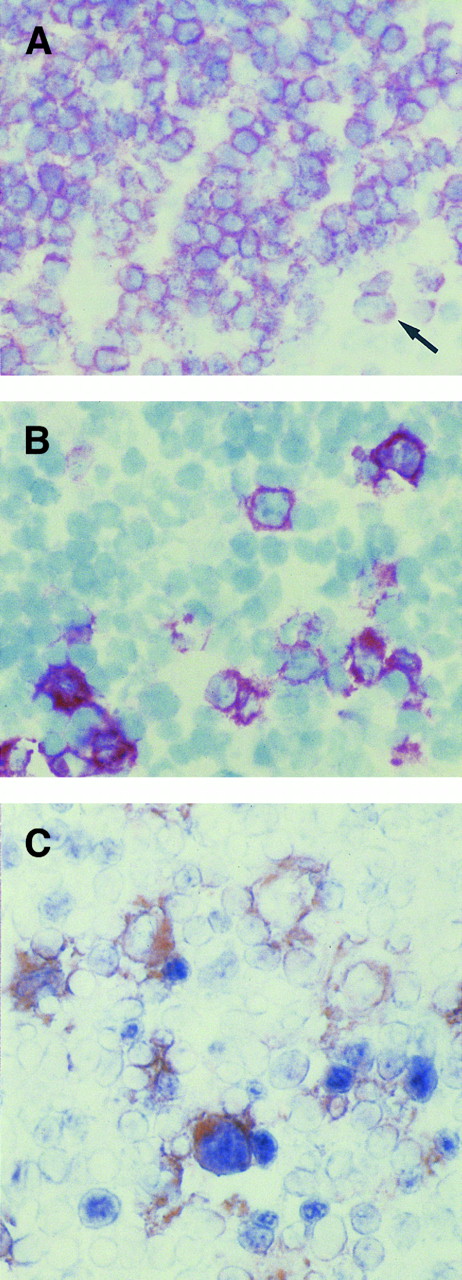 Fig. 3. (A, B, and C) Serial sections from a reactive lymph node with non-neoplastic T-cell proliferation. In the interfollicular area, where almost all cells, including large cells (arrow), are positive for CD3 antigen (A), some CD30+ (B) large lymphocytes are present. (C) Coexpression of BCL-6 protein (nuclear, blue) is observed in a large CD30+ (cytoplasmic and membranous, reddish) cell, as detected by two-color staining (see Materials and Methods). Individual cells expressing either BCL-6 or CD30 are also seen. (A and B) APAAP immunostaining, hematoxylin counterstain, original magnification ×400; (C) frozen section, original magnification ×400.