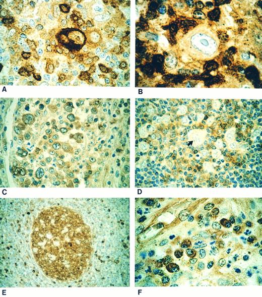 Fig. 1. (A) Classical Reed-Sternberg (RS) cell showing strong cytoplasmic CPP32 immunostaining. (B) Case showing a mononuclear variant of RS cell negative for CPP32 immunostaining. (C) Nodular sclerosis Hodgkin's disease showing positive CPP32 immunostaining of lacunar cells. (D) Negative staining lymphohistiocytic cell (arrow) in a case of nodular lymphocyte predominant Hodgkin's disease. (E) Strong CPP32-positive immunostaining of the germinal center of a secondary lymphoid follicle with negative staining of mantle zone cells. (F ) Plasma cells showing strong cytoplasmic positivity for CPP32 immunostaining.