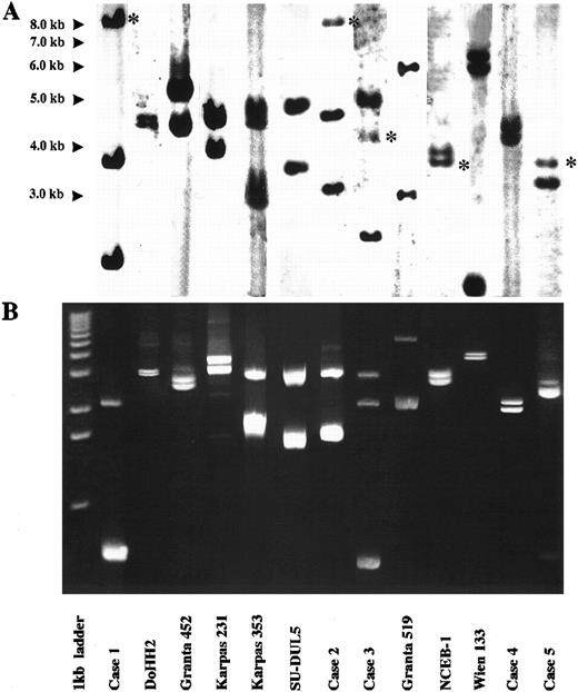 Fig. 2. Results of Southern blot with JH probe and LDI-PCR in cases studied. For each case, LDI-PCR products correspond in size to rearranged bands on Southern blot once unamplified distance between primers is allowed for. (A) Southern blot analysis of 10 μg of genomic DNA. Asterisks refer to germline bands. (B) Five microliters of LDI-PCR product was run on 0.8% agarose stained with ethidium bromide. A 1-kb ladder was used as a molecular weight marker.