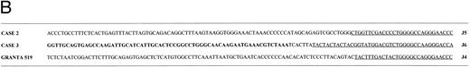 Fig. 4. BCL1 breakpoints. (A) Partial restriction map of the BCL1 locus illustrating cosmid and probe locations and breakpoints cloned in this study. Breakpoint of Granta 519 marked with its derived probe (p519ES, a 500-bp EcoRI/Sac I fragment). Note that this breakpoint falls within a window not covered by other probes. Map taken from Williams et al40 and Raynaud et al.41 (B) Sequences of breakpoints cloned in cases with t(11; 14); JH sequences are underlined and JH segment involved in breakpoint is shown. Bold type refers to Alu repeats. B, BamHI; E, EcoRI; H, HindIII; S, Sac I.