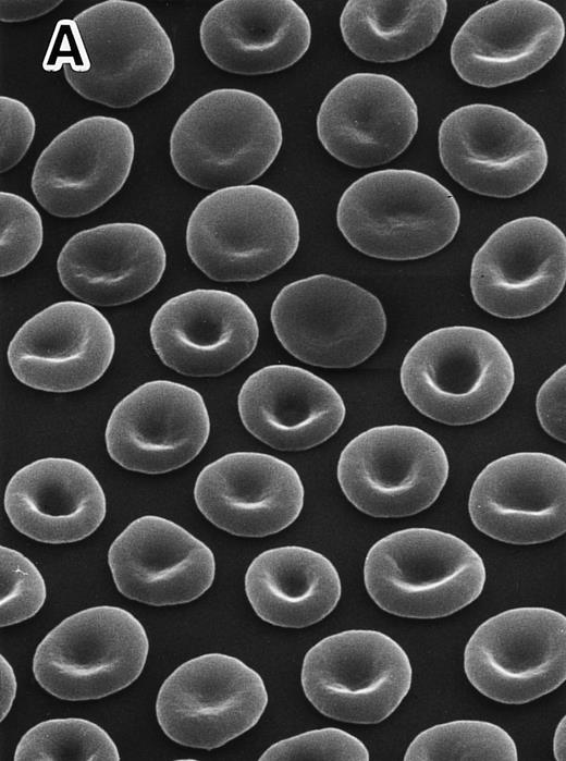 Fig. 1. Scanning electron micrographs of peripheral RBCs in a normal subject and the homozygous patient with total protein 4.1 deficiency. The patient was splenectomized in 1979. RBCs were fixed with 1% glutaraldehyde solution immediately after blood was drawn and transferred at 4°C. Striking poikilocytosis and anisocytosis were noted on the background of elliptocytosis in the 4.1 (−) Madrid case (B), compared with normal discocytes in a representative normal subject (A). Original magnification × 1,500.