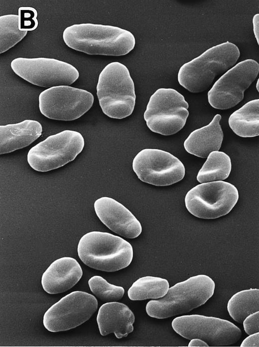 Fig. 1. Scanning electron micrographs of peripheral RBCs in a normal subject and the homozygous patient with total protein 4.1 deficiency. The patient was splenectomized in 1979. RBCs were fixed with 1% glutaraldehyde solution immediately after blood was drawn and transferred at 4°C. Striking poikilocytosis and anisocytosis were noted on the background of elliptocytosis in the 4.1 (−) Madrid case (B), compared with normal discocytes in a representative normal subject (A). Original magnification × 1,500.