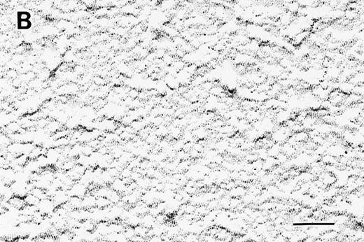 Fig. 2. Electron micrographs of RBC membrane skeletons by the surface replica method with antihuman protein 4.1 mouse monoclonal IgM antibody. No protein 4.1 was detected in the 4.1 (−) Madrid (B) as compared with normal subjects (A). Original magnification × 100,000. Bars indicate 0.1 μm.