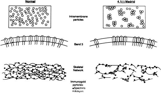 Fig. 7. Schematic diagrams of states of IMPs and the skeletal network in RBCs of normal and the 4.1 (−) Madrid case. The upper and the middle portions indicate the sizes and distribution patterns of IMPs in normal (left) and the 4.1 (−) Madrid case (right). The clustering of the normal-sized IMPs is evident in the 4.1 (−) Madrid case. The bottom portions represent the states of the skeletal network of normal (left) and the 4.1 (−) Madrid case (right). (•) Antispectrin antibody-conjugated immunogold particles; (○) antiankyrin antibody-conjugated immunogold particles. The skeletal network in the 4.1 (−) Madrid case is markedly disrupted, which is proven by the abnormal distribution of the immunogold particles for spectrin. Ankyrin tends to cluster more than spectrin in the 4.1 (−) Madrid case.