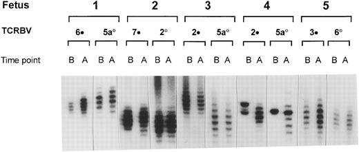 Fig. 2. Radioactive spectratype of selected CD4+ TCRBV families of IUT-treated patients. Selection was based on the most (•) and least (○) pronounced alterations during the course of IUT treatment. PCR products were analyzed on a phosphor-imager before (B) and after (A) the start of treatment.