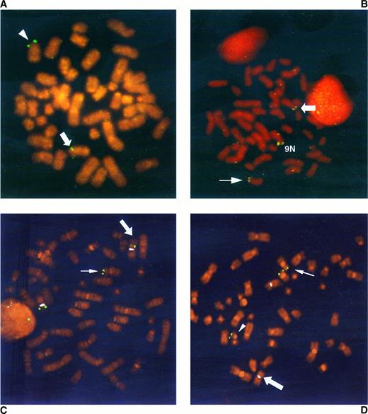 Fig. 1. FISH analysis of the ETV6 and JAK2 rearrangements in the ALL case (A and B) and the ALL case (C and D). Hybridization with cosmid 54D5, which spans the 12p13 breakpoint in the CML case, is shown in (A) and (C). Thick arrows indicate the der(12), thin arrows indicate the der(9), and the arrowhead points to the normal 12. (B and D) Hybridization with a mixture of the PACs containing JAK2 and spanning the 9p24 breakpoint. Thin and thick arrows indicate, respectively, the der(9) and the der(12); the arrowhead shows the der(15)t(9; 15; 12); 9N indicates the normal chromosome 9. In (C) and (D) hybridization of a centromere 12 probe is shown in white.