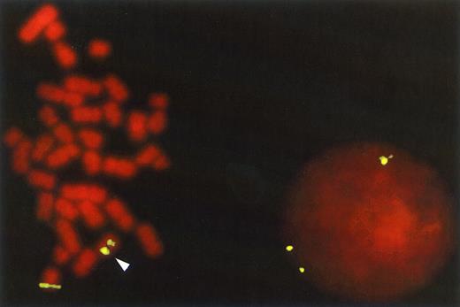 Fig. 1. FISH with the 16p13 YAC probe on AML cells from patient 10 that contained the inv(16) (p13q22) abnormality. The chromosomal rearrangement is shown in the metaphase cell by the splitting of the hybridization signal between the p and q arm of the abnormal chromosome 16 while the normal chromosome retains only one signal. In the interphase cell this abnormality is detected by the presence of three fluorescent signals rather than the normal two. The 16p13 YAC probe was prepared and labeled with digoxigenin as described in Materials and Methods and detected with FITC-labeled anti-digoxigenin. The counterstain is propidium iodide (original magnification × 630).