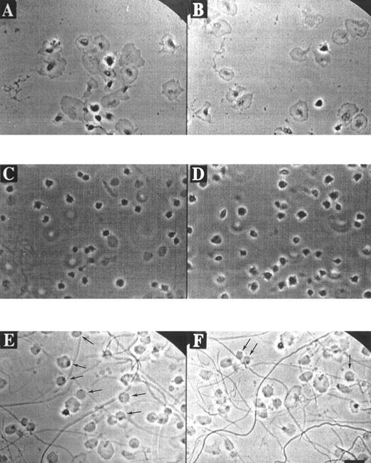 Fig. 1. Morphology of platelets on fibrinogen or collagen matrices. Platelets in suspension were allowed to adhere to a coverslip coated with fibrinogen (A through D) or collagen (E and F ) in the presence of 2 mmol/L CaCl2 and 0.2 U/mL apyrase. Phase-contrast images were continuously recorded with a bright-field camera. Video prints are shown from various microscopic fields after 20 minutes of adhesion to immobilized fibrinogen in the absence (A and B) or presence (C and D) of 10 μmol/L H-Arg-Gly-Asp-Ser-OH. Video prints are also shown from two fields after 20 minutes of adhesion to collagen (E and F ). Note the rounded, balloon-like platelets with small dark spots, attached to the collagen fibers (E and F, arrows). Bar indicates 5 μm.
