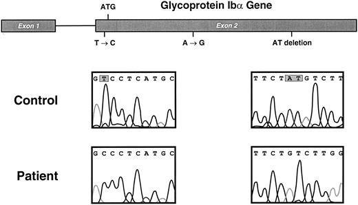 Fig. 3. GP Ibα gene and mutations in the Bernard-Soulier patient. Sequencing results from the patient and from a control subject are compared in the bottom 2 panels, with the mutated nucleotides shown enclosed in gray boxes. The position of the mutations in the GP Ibα gene are depicted above.