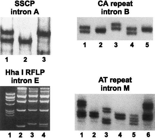 Fig. 1. Analysis of four polymorphic markers in introns A, B, E, and M of the FXI gene. SSCP in intron A: an autoradiogram shows samples of a heterozygote for alleles 1/2 (lane 1), a homozygote for allele 2 (lane 2), and a homozygote for allele 1 (lane 3). CA repeat in intron B: an autoradiogram shows samples of a heterozygote 2/4 (lane 1), a homozygote for allele 3 (lane 2), a heterozygote 1/2 (lane 3), a heterozygote 2/4 (lane 4), and a homozygote for allele 2 (lane 5). RFLP in intron E: an ethidium bromide–stained agarose gel shows in lane 1 the pBR322 DNA/Alul marker, samples of homozygotes for allele 2 (lane 2) and allele 1 (lane 3), and a sample of a heterozygote for alleles 1/2 (lane 4). AT repeat in intron M: an autoradiogram shows samples of a heterozygote for alleles 1 and 3 (lane 1), a homozygote for allele 3 (lane 2), a heterozygote for alleles 2 and 4 (lane 3), a homozygote for allele 3 (lane 4), a heterozygote for alleles 3 and 4 (lane 5), and a heterozygote for alleles 1 and 3 (lane 6).