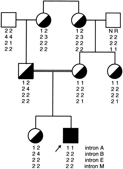 Fig. 3. Pedigree of a Yemenite Jewish family depicting a proband with severe FXI deficiency (less than 1 U/dL) caused by homozygous type II mutation and six family members who are heterozygotes. It can be seen that the 1-2-2-2 haplotype segregates with the type II mutation as in Iraqi and Ashkenazi Jewish and Arab chromosomes bearing this mutation (Fig 2).