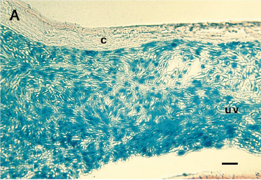 Fig. 1. Successful intraocular gene transfer using replication-deficient adenovirus vector in a nude mouse model. (A) β-Galactosidase reporter gene expression in intraocular human uveal melanomas treated in oculi with AdCMV-βGal vector. (B) PAI-1 antigen expression in human uveal melanoma treated in oculi with AdCMV-PAI-1 vector. A murine IgG1 antihuman PAI-1 MoAb was used to detect human PAI-1 expression in paraffin-embedded eyes using an immunoperoxidase procedure described elsewhere. (C) Absence of immunohistochemical staining in OCM-1 melanomas treated with AdCMV-PAI-1 and exposed to peroxidase-conjugated secondary antibody and substrate. c, cornea; uv, uveal melanoma. Bar = 80 μm.
