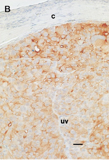 Fig. 1. Successful intraocular gene transfer using replication-deficient adenovirus vector in a nude mouse model. (A) β-Galactosidase reporter gene expression in intraocular human uveal melanomas treated in oculi with AdCMV-βGal vector. (B) PAI-1 antigen expression in human uveal melanoma treated in oculi with AdCMV-PAI-1 vector. A murine IgG1 antihuman PAI-1 MoAb was used to detect human PAI-1 expression in paraffin-embedded eyes using an immunoperoxidase procedure described elsewhere. (C) Absence of immunohistochemical staining in OCM-1 melanomas treated with AdCMV-PAI-1 and exposed to peroxidase-conjugated secondary antibody and substrate. c, cornea; uv, uveal melanoma. Bar = 80 μm.