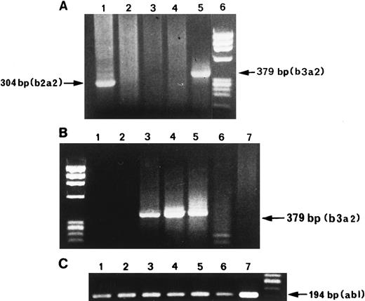 Fig. 1. RT-PCR products of BCR-ABL mRNA amplification of ET Ph-neg patients. (A) Lane 1, patient with b2a2 trascript; lanes 2 and 3, patients without BCR-ABL trascripts; lane 4, HL-60 negative control; lane 5, positive control extracted from K562 cells diluted 1:105 with HL-60 negative cells; lane 6, molecular marker. PCR products of b3a2 trascript (B) and ABL (C) of five bone marrow samples. Lanes 1, 2, and 6, patients without BCR-ABL transcript; lane 3, positive control; lanes 4 and 5, positive patients; lane 7, HL-60 negative control.