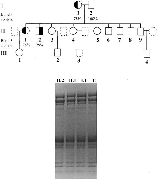 Fig. 1. Pedigree of the studied family and SDS-PAGE (nonlinear gradient containing 3.5% to 17% of polyacrylamide) stained by Coomassie blue: (◐) (╡) members with spherocytosis; (○) (□) members with normal hemoglobin levels, reticulocyte counts and osmotic fragility; () () members not available for study.