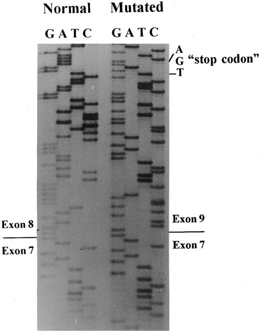 Fig. 3. Band 3 cDNA sequencing. Sequencing of subclones containing the normal or the mutated band 3 allele showed skipping of exon 8 in the patient with the mutation in the position + 1G → T of intron 8.