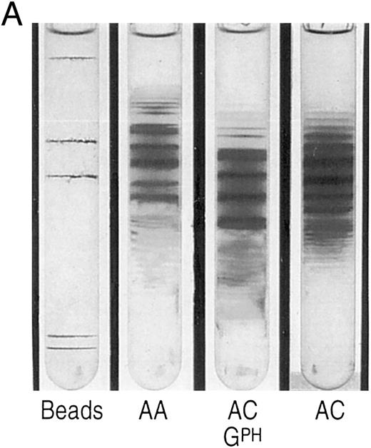 Fig. 1. (A) Percoll-Larex gradient of an AA control, and AC control, and the mother of the propositus AC α-G-Philadelphia. Density marker beads are included as reference. Notice the significant increase of denser cells in the blood of the propositus' mother compared to that of a C trait individual without α-G-Philadelphia. (B) Comparison of AA, SC and the propositus (SC α-G-Philadelphia). Notice increase in the very dense cells (crystal containing) as well as more light cells.