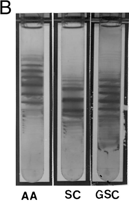 Fig. 1. (A) Percoll-Larex gradient of an AA control, and AC control, and the mother of the propositus AC α-G-Philadelphia. Density marker beads are included as reference. Notice the significant increase of denser cells in the blood of the propositus' mother compared to that of a C trait individual without α-G-Philadelphia. (B) Comparison of AA, SC and the propositus (SC α-G-Philadelphia). Notice increase in the very dense cells (crystal containing) as well as more light cells.