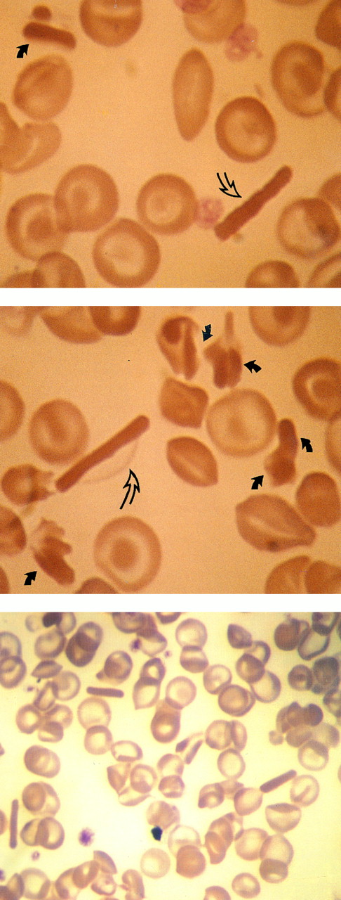 Fig. 2. Smears from fingerstick collected blood (propositus). Upper panel: low power magnification, 3 “sugar cane” crystals are observed in one field. Middle and lower panels: full arrows point to intraerythrocytic tetragonal crystals. In the middle panel, the crystal is contained within a red cell membrane (open arrows) and all its Hb content has been included in the crystal. The lower panel shows the crystal without the red cell membrane.