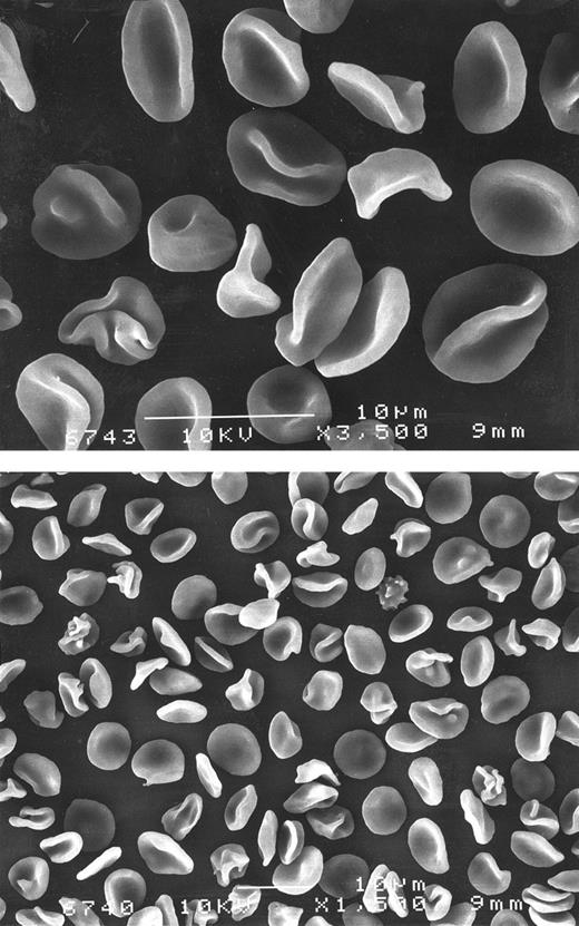 Fig. 3. Scanning microscopy in the propositus whole blood. Upper panel: shows abundant folded cells and stomatocytes at 3,500 magnification. Lower panel: corresponds to the same sample shown in upper panel. Original magnification × 1,500.