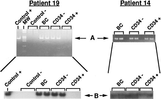 Fig. 4. PCR detection of BCL2/JH rearrangement. Two representative results from unprocessed and processed BM are shown. Left panel: Data from patient 19 (disappearance of the BCL2/JH translocation in the CD34+ cell fraction). Right panel: Data from patient 14 (persistance of the BCL2/JH translocation in the CD34+ cell fraction). Control+, RL cells; Control−, normal PB lymphocytes; BC, DNA extracted from buffy coat (unprocessed BM); CD34−, DNA extracted from unadsorbed CD34− cell fraction; CD34+, DNA extracted from adsorbed CD34+ cell fraction; MW, molecular weight markers. Arrows show the specific BCL2/JH+ band.