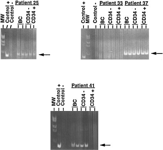 Fig. 5. PCR detection of IgH rearrangement. Four representative results from unprocessed and processed BM and PBPC are shown. Left upper panel: Data from patient 25 (persistance of the IgH rearrangement in the CD34+ cell fraction of BM). Right upper panel: Data from patients 33 (negativity of the IgH rearrangement in the three fractions) and 37 (persistence of the IgH rearrangement in the CD34+ cell fraction of PBPC). Lower panel: Data from patient 41 (disappearance of the IgH rearrangement in the CD34+ cell fraction of PBPC). Control+, B-ALL cells; Control−, normal PB lymphocytes; BC, DNA extracted from buffy coat (unprocessed BM or unprocessed PBPC); CD34−, DNA extracted from the unadsorbed CD34− cell fraction; CD34+, DNA extracted from the adsorbed CD34+ cell fraction; MW, molecular weight markers. Arrows show the specific abnormal JH rearranged band.