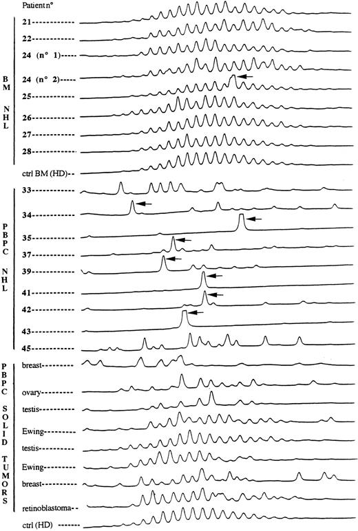 Fig. 6. IgH electrophoretograms produced by gene scanning software of PCR-amplified DNA extracts from unprocessed BM and PBPC products and from various control samples. Lines 1 to 8, samples 21, 22, and 24 to 28 from BM of NHL patients. Lines 3 and 4 corresponded to BM samples of patient 24 collected at a 3-month interval. Line 9, control BM of a healthy donor (HD). Lines 10 to 18, samples 33 to 35, 37, 39, 41 to 43, and 45 from PBPC of NHL patients. Lines 19 to 26, control samples from various solid tumors. Line 27, control blood from a healthy donor (HD). Abnormal peaks are indicated by an arrow (➭). Please note that in the ethidium bromide staining technique, samples 21, 22, 24, 26, 27, 28, 33, 45 and the controls were found negative, while samples 25, 34, 35, 37, 39, 41, 42, and 43 were found positive.