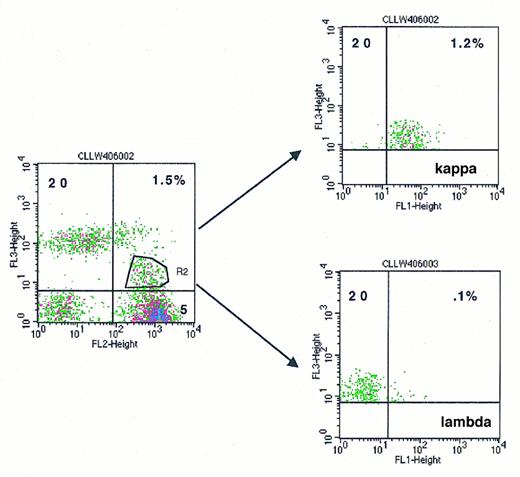 Fig. 2. The use of three-color analysis to detect minimal disease in CLL. CLL cells have been diluted to 1% in normal peripheral blood. (A) Plot of CD5 versus CD20 is used to gate dual-positive cells with weak CD20 in the left sided histogram. These gated cells are then plotted on the right-sided histograms for both CD20 versus κ and CD20 versus λ, showing clonality with a12:1 ratio of κ to λ for the dual CD5, CD20+ cells.