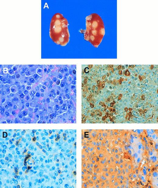 Fig. 2. NPM-ALK–induced lymphoid tumors. (A) Macroscopic appearance of subcapsular lymphomas metastatic to the kidney in animal GT4 showing bilateral multifocal involvement (original magnification × 1.5). (B) Hematoxylin and eosin-stained section of mesenteric lymphoma from mouse GT4 showing a uniform population of large immunoblastic cells with basophilic cytoplasm, centrally located nuclei, and distinct nucleoli (original magnification × 275). (C) Immunostaining with an anti-ALK antibody shows staining of the nucleoli as well as the cytoplasm of lymphoma cells, with heterogeneity in level of NPM-ALK expression evident among the tumor cells (original magnification × 275). (D) Immunostaining with an anti-CD3 antibody shows CD3− tumor cells and some admixed CD3+ normal mouse lymphocytes (original magnification × 275). (E) Immunostaining of tumor cells is positive with an anti-IgM antibody, with infiltrating normal T lymphocytes serving as a negative internal control (original magnification × 275).
