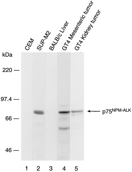 Fig. 3. Immunoblot analysis of NPM-ALK protein expressed in mouse lymphomas. Lane 1 contains protein extracts from the human T-cell leukemia line CEM, which does not contain the t(2; 5), whereas lane 2 contains extracts from the t(2; 5)-positive lymphoma line SUP-M2. Lane 3 contains protein extracts from the liver of a normal BALB/cByJ mouse, whereas lanes 4 and 5 contain proteins prepared from mesenteric node or subcapsular renal tumors, respectively, from mouse GT4. The arrow indicates the position of the 75-kD NPM-ALK fusion protein. The smaller immunoreactive bands present in lane 4 probably represent partial proteolytic degradation of the NPM-ALK protein in the tumor sample.