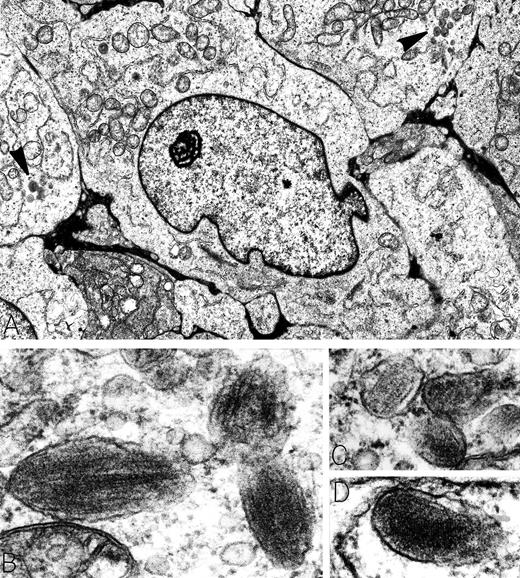 A 29-year-old man presented with a 20-pound weight loss and was found to have a large retroperitoneal mass. Electron microscopy was diagnostic for metastatic amelanotic melanoma, characterized by large tumor cells with prominent nucleoli and focal clusters of membrane-bound, ellipsoid granules (arrowheads in A). Higher magnification of these organelles showed that they were premelanosomes containing perpendicular striated filaments (B and C) or parallel lamellar arrays (D). Extremely electron-dense melanin was absent from the premelanosomes. Immunoperoxidase stains of tumor cells were positive for the melanoma-associated antigen HMB-45 and negative for leukocyte common antigen, B-cell antigen (CD20 and CD19), T-cell antigens (CD2, CD3, CD4, CD5, and CD8), and lymphoid activation antigens (CD30 and CD15). Retrospectively, the patient was stated to have fair skin, numerous freckles, and red hair; no history of excesssive sunburns or skin lesions was elicited. Original magnifications: (A) ×8,000; (B) ×90,000; (C) ×71,500; and (D) ×91,000. (Courtesy of Ann M. Dvorak, MD, Department of Pathology, Beth Israel Deaconess Medical Center, 330 Brookline Ave, Boston, MA 02215.)