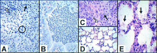 Fig. 5. Variable cellular composition of inflammatory infiltrates and novel aspects of pulmonary pathology in growth factor–deficient mice. (A) Cellular inflammatory infiltrate surrounding an intraabdominal abscess in a 73-week-old female G−/− mouse illustrating the scarcity of neutrophils (circled) and the predominance of lymphocytes (solid arrow) and macrophages (hollow arrow). Cultures from this abscess grew both Proteus mirabilis and Enterococcus species. (B) Representative view of the cellular inflammatory infiltrate within a bronchiole in an area of pneumonia in a 71-week-old GM−/− mouse illustrating the predominance of morphologically normal neutrophils. (C) Cellular inflammatory infiltrate surrounding a pulmonary abscess in a 37-week-old female G−/−GM−/− mouse illustrating the scarcity of neutrophils, with the majority of cells being lymphocytes (solid arrow) and macrophages (hollow arrow). (D) Representative field of lung abnormality in a 45-week-old female G−/− animal showing marked hypercellularity of alveolar septae in the absence of pulmonary infection (compare with appearance of normal alveolar septae in GM−/− mice in Fig 3A). (E) Similar appearance of alveolar septae in a 64-week-old male G−/−GM−/− mouse with relatively minor surfactant accumulation (arrows). (All sections are stained with H & E; C is original magnification ×2,040, and all others are ×1,360.)