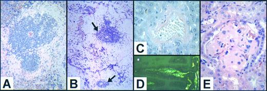 Fig. 6. Range of manifestations of amyloidosis in growth factor–deficient mice. (A) Moderate (grade 2) splenic amyloid in an infected 50-week-old female G−/− mouse demonstrating the usual pattern of perifollicular localization of homogeneous acellular eosinophilic material with relative preservation of the splenic white pulp (original magnification ×340, H & E). (B) Extensive (grade 3) confluent splenic amyloid deposits in a 67-week-old female G−/−GM−/− animal with residual atrophic lymphoid follicles (arrows). The mouse was culled due to the presence of a soft-tissue abscess that grew S aureus (original magnification ×340, H & E). (C) Congo red positively stained hepatic amyloid deposition around the central vein in an 81-week-old female G−/−GM−/− mouse (original magnification ×1,360, Congo red). (D) Intestinal amyloid within the submucosa of villi showing characteristic green birefringence when viewed under crossed polarizing filters (same animal as C); original magnification ×1,360, Congo red). (E) Renal amyloid resulting in obliteration of the normal glomerular vasculature in a 48-week-old male G−/−GM−/− mouse (original magnification ×1,360, H & E).