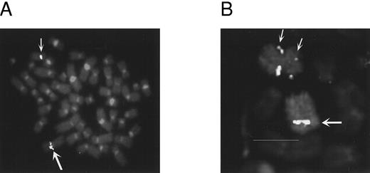Fig. 2. FISH analysis. (A) UPN 03 hybridized with YAC 782H11. Large arrow indicates the der(8) and the small arrow indicates the normal chromosome 8. (B) UPN 04 hybridized with YAC 829D12 and a chromosome 8 painting probe. Large arrow shows the normal chromosome 8; the small arrows show the split signal on the inv(8).