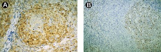 Fig. 1. Expression of cyclin D1 and cyclin D3 in a case of MCL. (A) MCL cells staining positively for cyclin D1. Note negative staining reaction in the residual germinal center. (B) Cyclin D3 is strongly expressed by B cells of the residual germinal center whereas MCL cells react negatively.